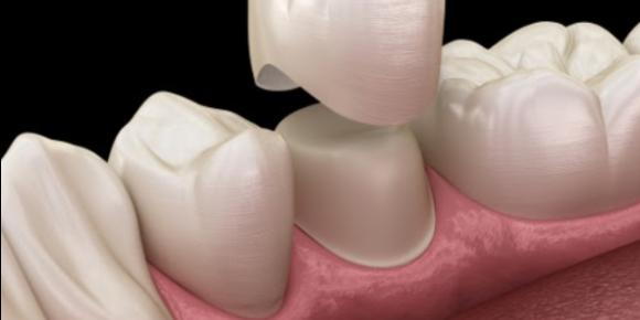 What Are The Common Causes Of Bite Pain On A Crowned Tooth