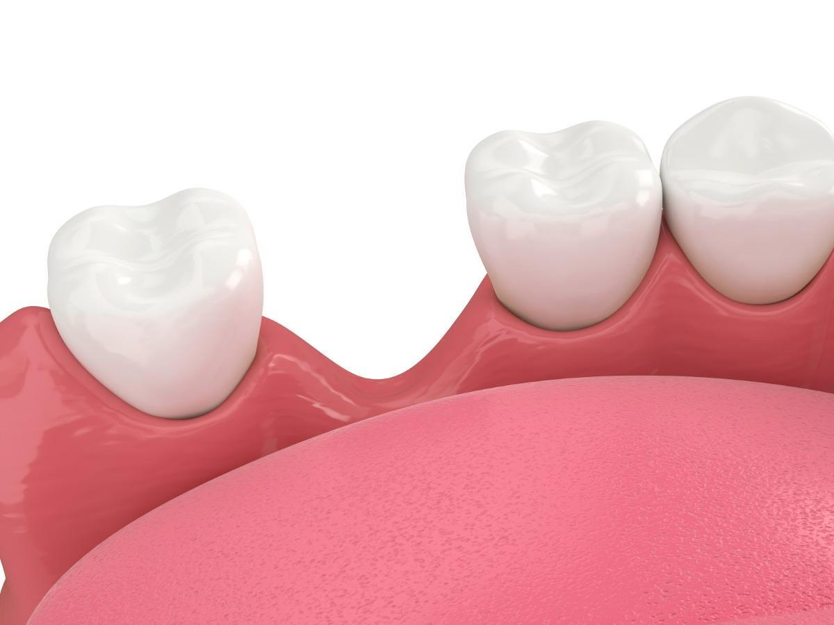 Dental Treatment Options to Repair a Cracked Tooth - Lasting Impressions  Dental Group Houston TX