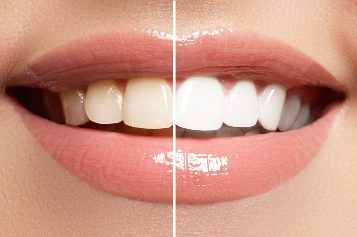 This is a split image of a woman’s mouth. The left half shows stained, yellowish teeth. The right half shows bright white teeth. She is smiling. Her eyes and nose can not be seen.