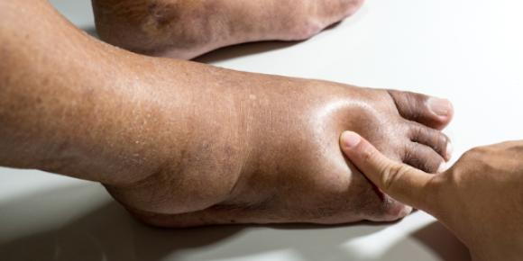What Causes Swollen Feet?
