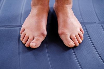 Top-View-of-Feet-Suffering-From-Bunions