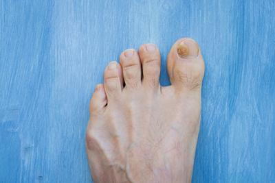 Fungus toenail in a persons foot