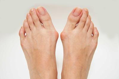 Bunions condition on person