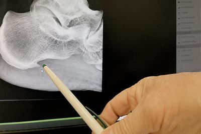 Podiatrist reviewing a foot X-ray and pointing at heel spur areas.