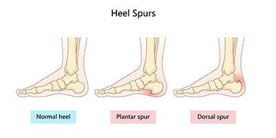 Diagram of foot with normal anatomy, dorsal spur, and plantar spur