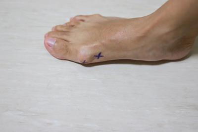 Illustration of bunion condition