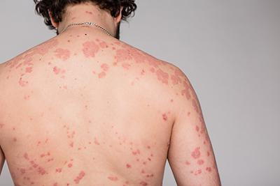 How to Deal with Your Psoriasis Symptoms