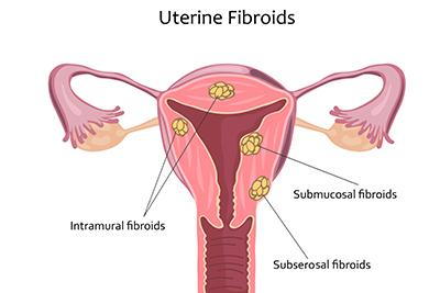 Uterine fibroid illustration with labeled fibroid types