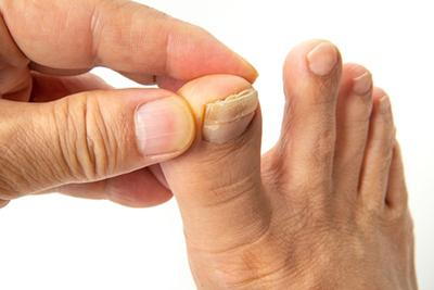 Toenail fungus on a persons foot