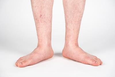 Flat-Feet-Also-Known-as-Pes-Planus-or-Fallen-Arches