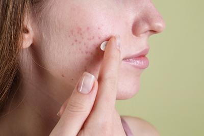 Woman-With-Acne-Problem-Tried-Topical-Treatment