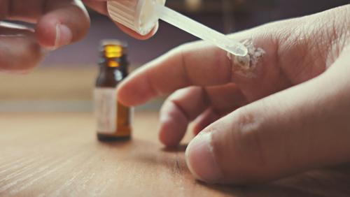 Close-up of wart being treated with salicylic acid