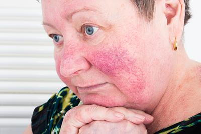 Unhappy-Senior-Woman-Suffering-from-Rosacea