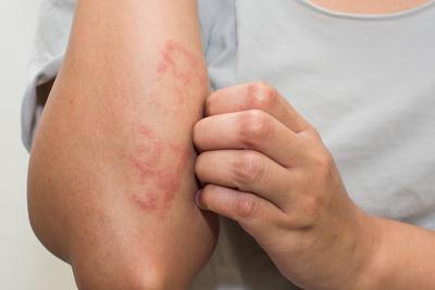 Person scratching dry red patch on arm due to eczema or dry skin