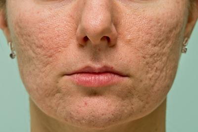 Close-up-of-a-Woman-with-Acne-Scarred-Skin