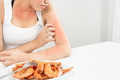 Woman develops hives on skin due to shrimp allergy