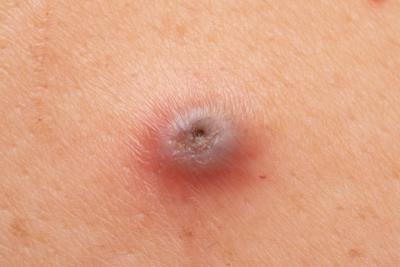 Illustration of Folliculitis on skin