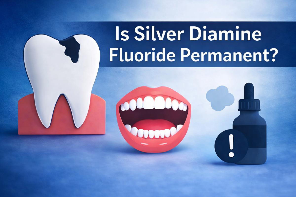 Is Silver Diamine Fluoride Permanent?