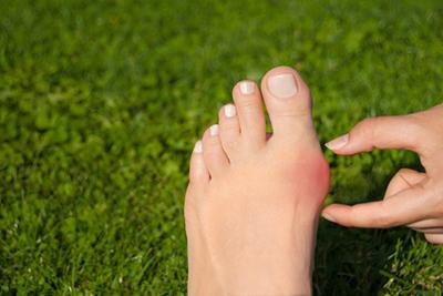Woman-Showing-Her-Bunion-Outdoors