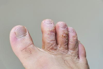 Close-up-Picture-of-a-foot-with-a-Condition-Called-Athlete's-Foot