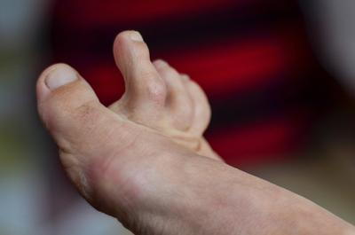 Hammertoe-condition-in-a-foot-of-a-person.