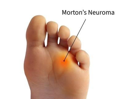 Illustration-of-Neuroma's-Pain