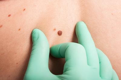 Skin removal of mole on a person skin.