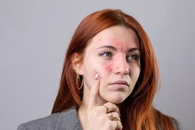 Woman suffering from acne in her face.