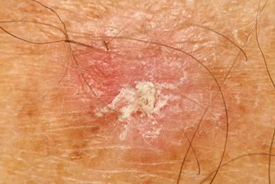 Pre-cancerous skin lesion caused by actinic keratosis in close-up.