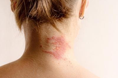 Woman with eczema in the back.