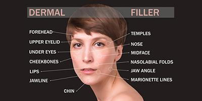 Woman’s face with marked dermal filler zones