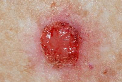 Illustration of Basal Cell Carcinoma on skin