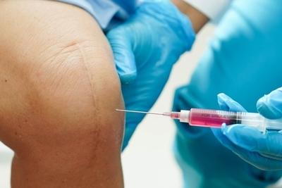 Illustration of PRP Treatment on patient