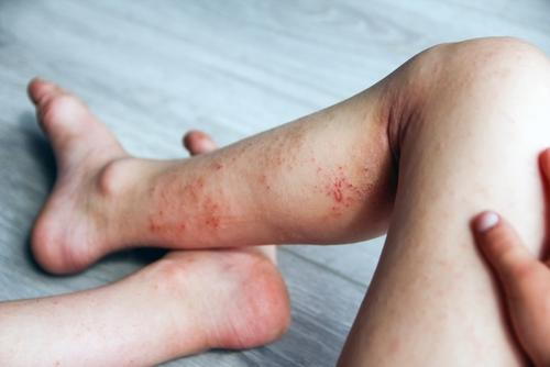 A child with visible eczema patches on the legs.