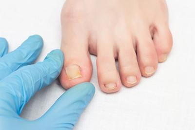 Patient-with-Ingrown-Toenail-Visits-Foot-Doctor