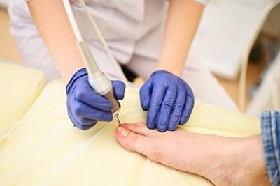 Laser-Treatment-for-Fungal-Nails-with-Your-Skilled-Foot-Doctor