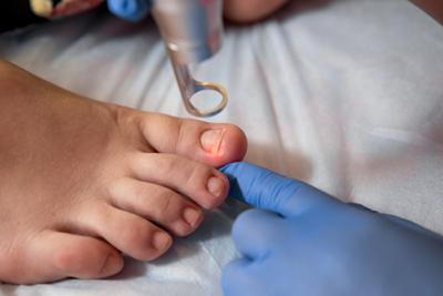 advanced fungal nail treatment with laser in bloomington indiana