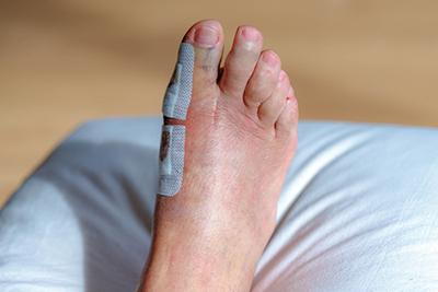 Surgical site on the foot with bandages and stitches following a bunion correction procedure.