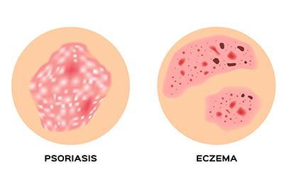 Psoriasis-and-Eczema-Illustration