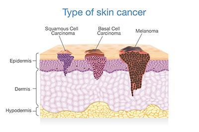 Medical illustration of basal cell, squamous cell, and melanoma