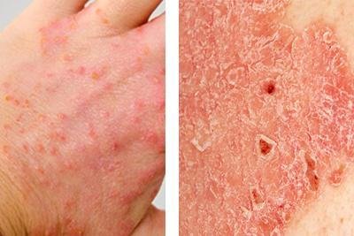 Comparison of eczema and psoriasis skin conditions