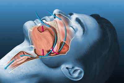 Illustration-of-Airway-Obstruction-in-Sleep-Apnea