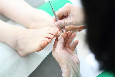 Ingrown-Toenail-Treatment