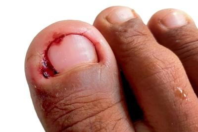 Severe-Ingrown-Toenail-in-Person-Foot-with-Blood.