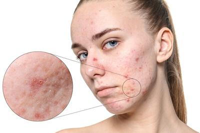 Woman-with-Acne-Problem