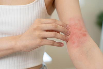 How to Identify Different Types of Skin Rashes