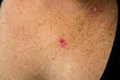 Woman with visible skin cancer lesion on chest