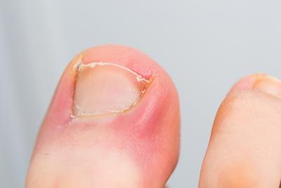 Close-up-of-an-Ingrown-Toenail-with-Redness-&amp;-Swelling