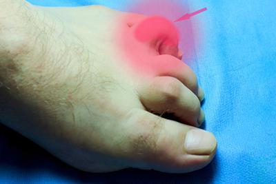 Detailed-View-of-a-Man’s-Foot-Affected-by-Hammertoe