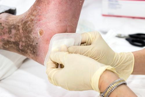 Clinical-assistant-putting-a-bondage-in-diabetic-foot-on-clinic..